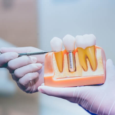 Closeup of dental implant model