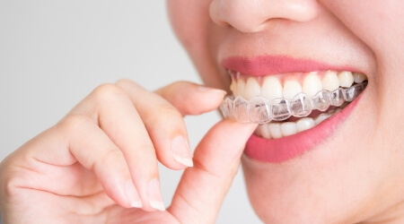 Closeup of dental patient placing an Invisalign tray