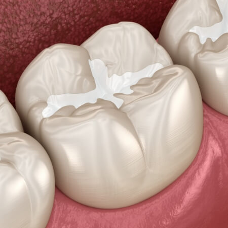 Closeup of animated smile with dental sealants